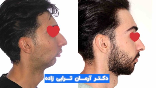 جراحی فک موفقیت آمیز کلاس ۲ دیپ بایت