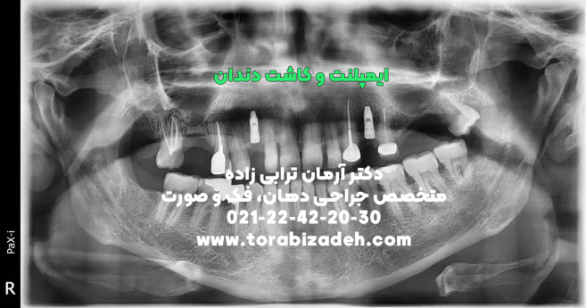 ایمپلنت تخصصی با دکتر آرمان ترابی زاده