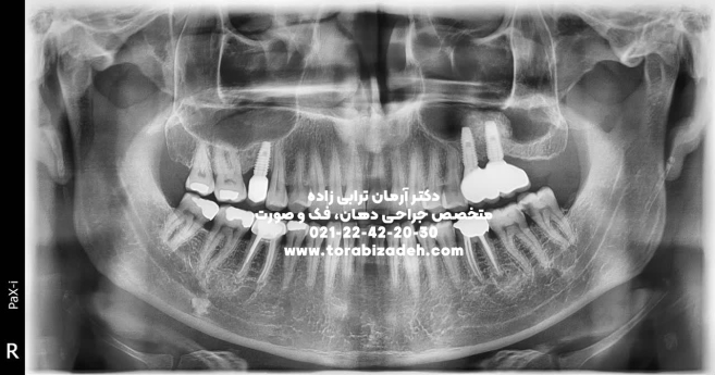 ایمپلنت تخصصی با دکتر آرمان ترابی زاده