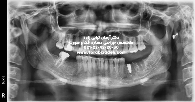 ایمپلنت تخصصی با دکتر آرمان ترابی زاده