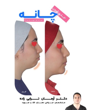 جراحی چانه توسط بهترین جراح فک و صورت ایران
