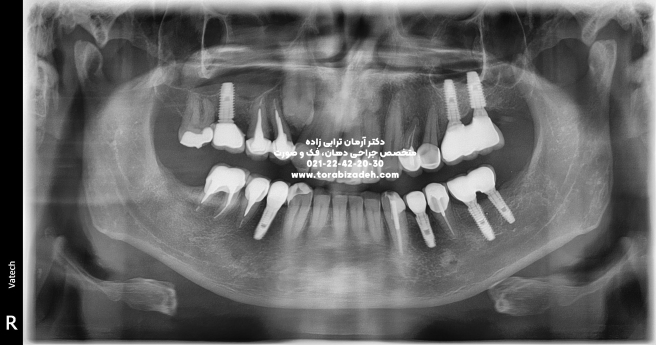 ایمپلنت تخصصی با دکتر آرمان ترابی زاده