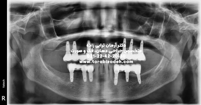 ایمپلنت تخصصی با دکتر آرمان ترابی زاده