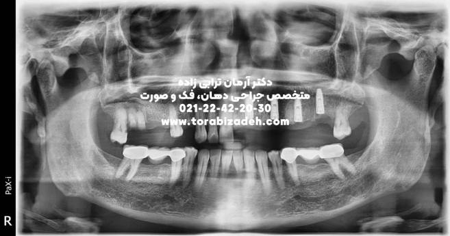 ایمپلنت تخصصی با دکتر آرمان ترابی زاده