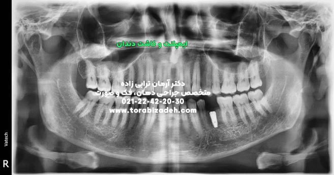 ایمپلنت تخصصی با دکتر آرمان ترابی زاده