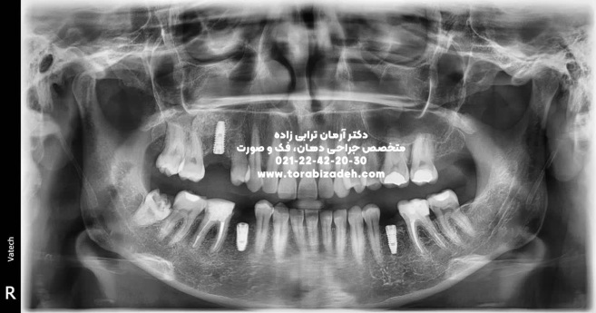 ایمپلنت تخصصی با دکتر آرمان ترابی زاده