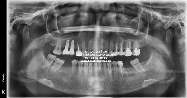 ایمپلنت تخصصی با دکتر آرمان ترابی زاده