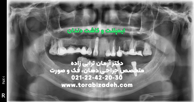 ایمپلنت تخصصی با دکتر آرمان ترابی زاده