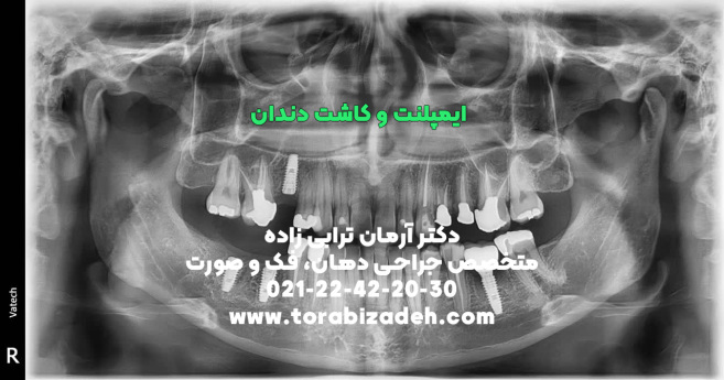 ایمپلنت تخصصی با دکتر آرمان ترابی زاده