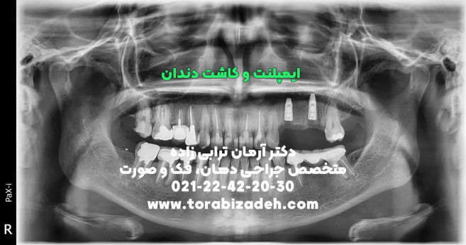 ایمپلنت تخصصی با دکتر آرمان ترابی زاده