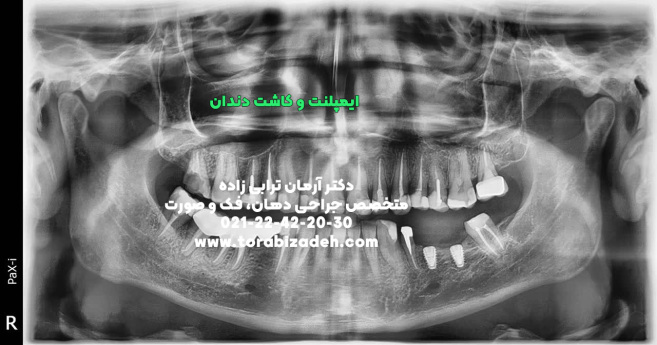 ایمپلنت تخصصی با دکتر آرمان ترابی زاده