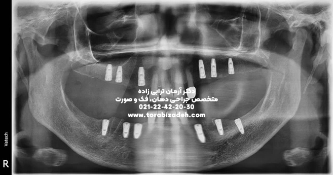 ایمپلنت تخصصی با دکتر آرمان ترابی زاده