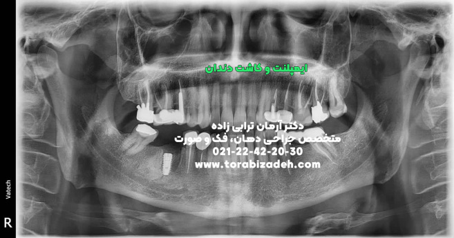 ایمپلنت تخصصی با دکتر آرمان ترابی زاده