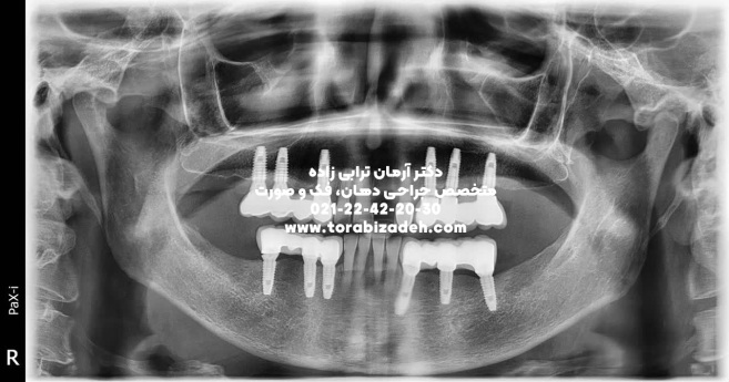 ایمپلنت تخصصی با دکتر آرمان ترابی زاده