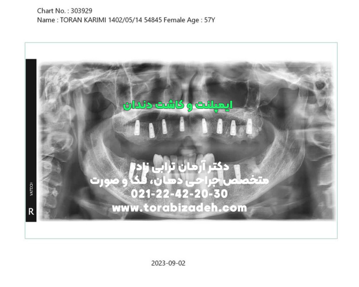 ایمپلنت تخصصی با دکتر آرمان ترابی زاده