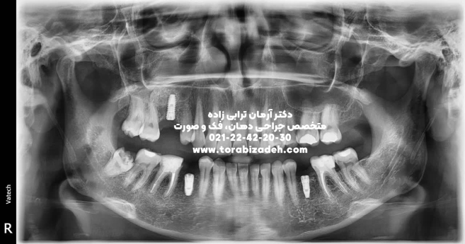 ایمپلنت تخصصی با دکتر آرمان ترابی زاده