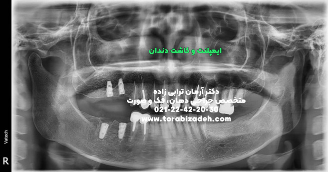 ایمپلنت تخصصی با دکتر آرمان ترابی زاده