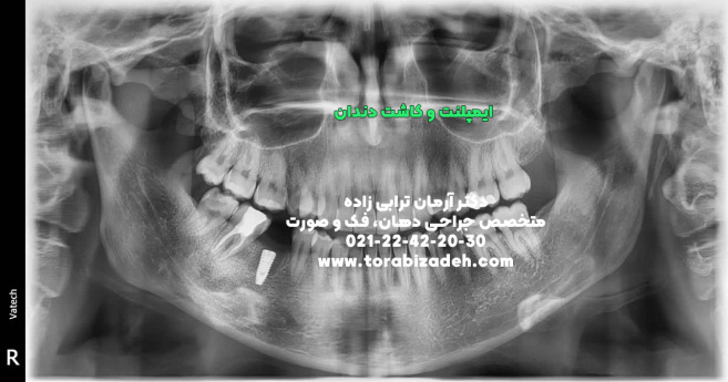 ایمپلنت تخصصی با دکتر آرمان ترابی زاده