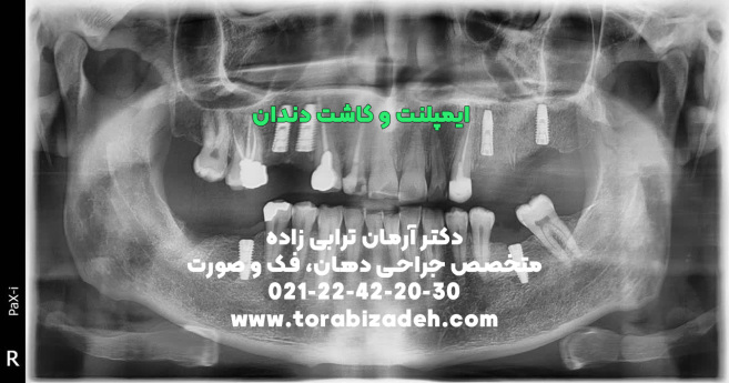 ایمپلنت تخصصی با دکتر آرمان ترابی زاده