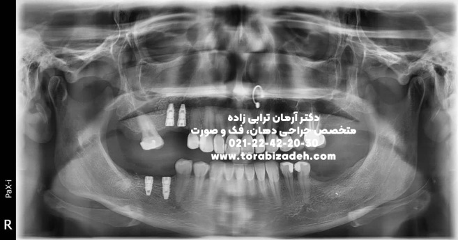 ایمپلنت تخصصی با دکتر آرمان ترابی زاده