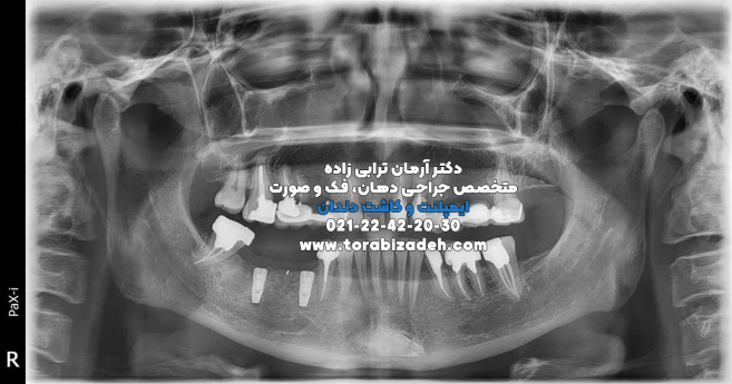 ایمپلنت تخصصی با دکتر آرمان ترابی زاده