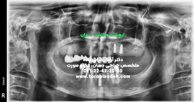 ایمپلنت تخصصی با دکتر آرمان ترابی زاده