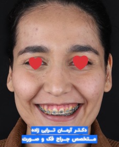 جراحی فک موفق برای اصلاح لبخند لثه ای