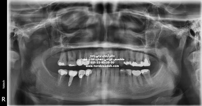 ایمپلنت تخصصی با دکتر آرمان ترابی زاده