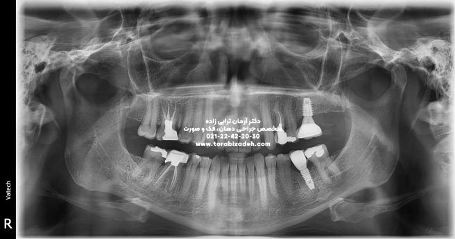 ایمپلنت تخصصی با دکتر آرمان ترابی زاده