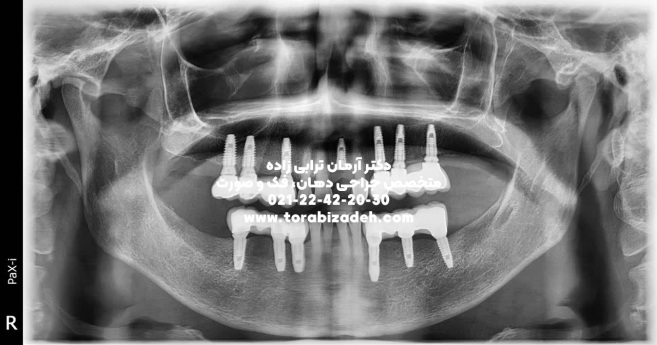 ایمپلنت تخصصی با دکتر آرمان ترابی زاده