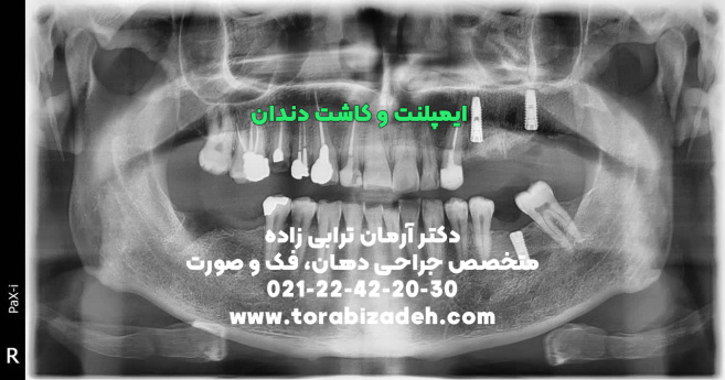 ایمپلنت تخصصی با دکتر آرمان ترابی زاده