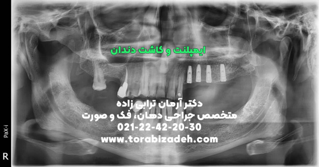 ایمپلنت تخصصی با دکتر آرمان ترابی زاده