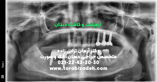 ایمپلنت تخصصی با دکتر آرمان ترابی زاده