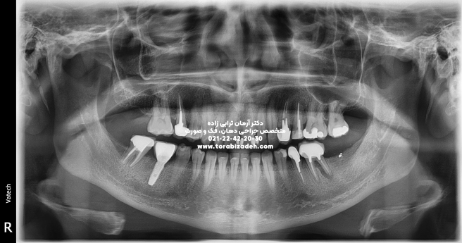 ایمپلنت تخصصی با دکتر آرمان ترابی زاده