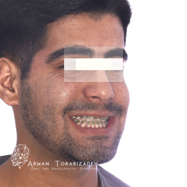بیمار بعد از جراحی فک با اپن بایت قدامی و کاهش ارتفاع قدامی صورت