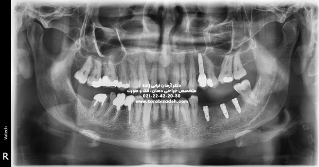 ایمپلنت با دکتر آرمان ترابی زاده