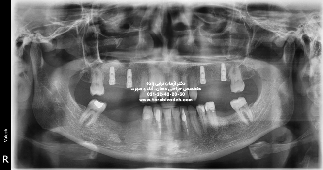 ایمپلنت تخصصی با دکتر آرمان ترابی زاده