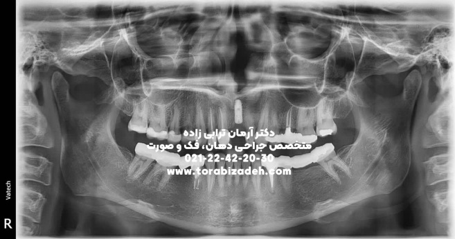 ایمپلنت تخصصی با دکتر آرمان ترابی زاده