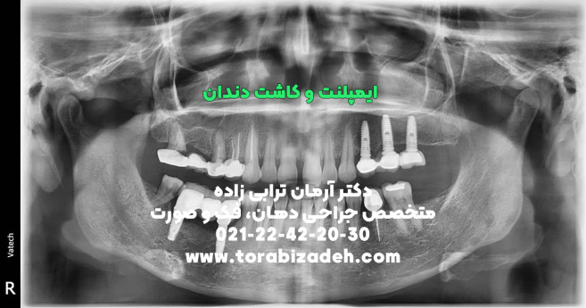 ایمپلنت تخصصی با دکتر آرمان ترابی زاده