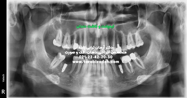 ایمپلنت تخصصی با دکتر آرمان ترابی زاده