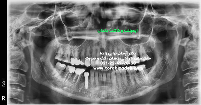 ایمپلنت تخصصی با دکتر آرمان ترابی زاده