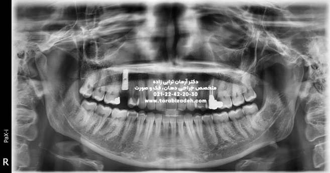 ایمپلنت تخصصی با دکتر آرمان ترابی زاده